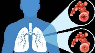 Common Symptoms of Epithelioid Mesothelioma [upl. by Eledoya]