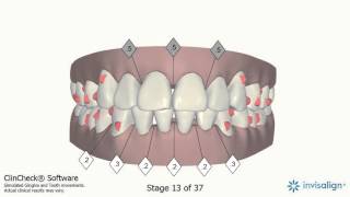 Andrew Chow Invisalign Mid Course Correction [upl. by Stephannie]