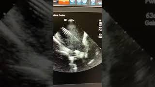 Echocardiography Essentials Evaluating right ventricular size and function [upl. by Hazlett173]