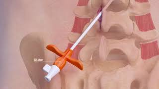 Dr Georgios Matis  Neuromodulation  ReActiv8 implantation procedure [upl. by Kent]