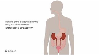 Creation of urostomy by removing bladder urethra  Ostomy surgery  Coloplast India [upl. by Olen]