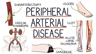 Understanding Peripheral Arterial Disease [upl. by Xylia]