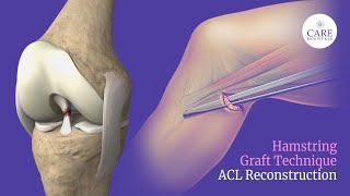 Hamstring Graft Technique for ACL Reconstruction  CARE Hospitals [upl. by Ferna]