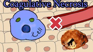 Coagulative Necrosis  Animation [upl. by Tioneb]