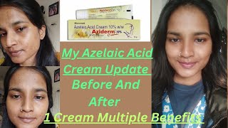 My Azelaic Acid Cream 10 Update  Before And After  Azidem Cream  1 Cream Multiple Benefits [upl. by Litton]