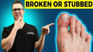 Stubbed Toe or Broken Toe Symptoms Pain Relief amp Treatment [upl. by Lerak454]