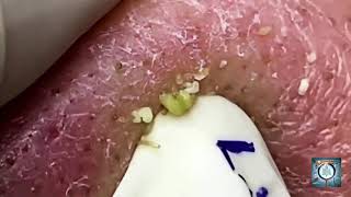 Pimple Popping BIG Blackheads Removal  Acne Treatment [upl. by Eikciv]