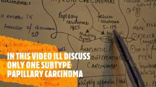 Thyroid carcinoma  papillary carcinoma [upl. by Schoening]