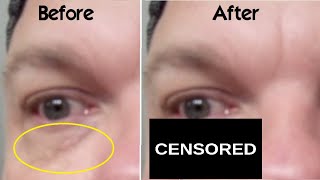 How Use Trichloroacetic Acid on Xanthelasma Spots Around Eyes at Home WARNING My BAD Experience TCA [upl. by Adirf]