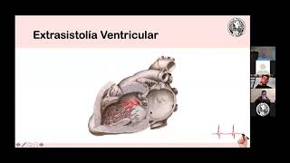 10 Fibrilación Auricular Flutter y Extrasístoles Dr Christian Karmelic 2021 [upl. by Llerod]