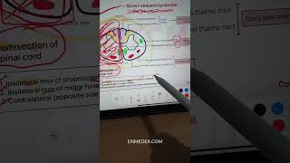 Brown Sequard Syndrome  Neurology inicet neetpg fmge [upl. by Anuaf119]