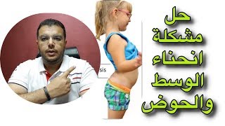 حل مشكلة انحناء الحوض والوسط للشلل الدماغي  Hyperlordosis correction [upl. by Resa]