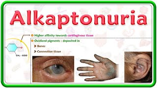 Alkaptonuria Black urine disease  Etiology Clinical features Diagnosis and Treatment  USMLE [upl. by Eemia]