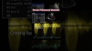 Pulmonary Stenosis on Echocardiography anatomy cardiology shorts [upl. by Karilynn]