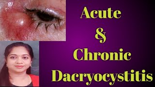 Dacryocystitis  Acute dacryocystitis Chronic Dacryocystitis Stages of Dcryocystitis Mucocele [upl. by Atikat811]