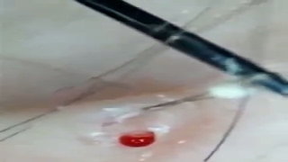 Removing big ingrown hair from Mans Knee [upl. by Tews]