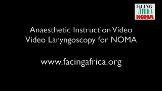 Anaesthesia Video Laryngoscopy in NOMA case with trismus [upl. by Addi975]