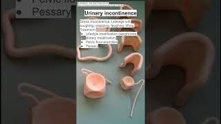 Urinary incontinence [upl. by Baxie]