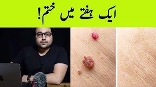 Dr ZeeHow to Rid Skin Tags and Warts  Quick fix  त्वचा के तिल [upl. by Edyak228]