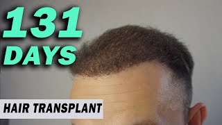 FUE Hair Transplant 131 DAYS post op Istanbul Turkey GROWTH STAGE [upl. by Yasdnyl]