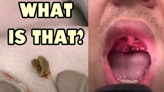 Throat Triple Feature Tonsil Stones Tonsillitis and Strep [upl. by Fisuoy]