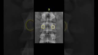 Testing Lumbar vertebrae using XRAYs shorts [upl. by Ylevol]