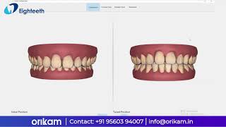 HELIOS 500 Orthodontics Simulation [upl. by Audwin]