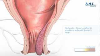 Hämorrhoiden Information Ursachen und Symptome [upl. by Okihsoy]