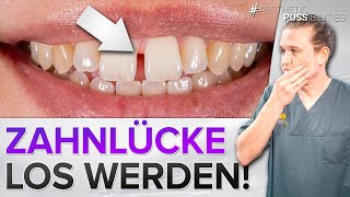 Zahnlücken  Diastema endlich geschlossen Komposit als günstige Lösung [upl. by Conny]