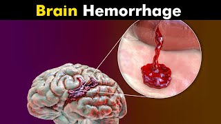 What Happens in Brain Hemorrhage  Symptoms Causes and Treatment UrduHindi [upl. by Alekim]