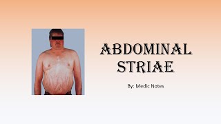 Abdominal striae  causes pathogenesis sign value [upl. by Uella]