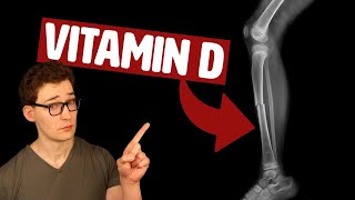 Does Vitamin D Supplementation actually improve Bone Health Study 329333 Analysis [upl. by Aihpledalihp431]