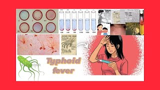 Typhoid fever everything we want to know [upl. by Anua]