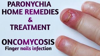 Paronychia Home remedies  Finger nail infection  skin infections  paronychia  finger infection [upl. by Conti]