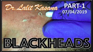 BLACKHEAD REMOVAL WITH COTTON BUDS AND EXTRACTOR PART1 by DrLalit Kasana [upl. by Abrahan]