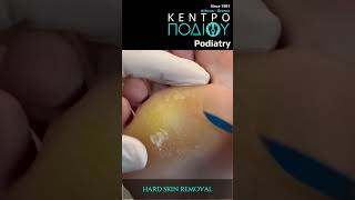 Hard Skin RemovalΑφαίρεση Σκληρύνσεων footpain κεντροποδιου feet foot callus podiatrist [upl. by Nari]