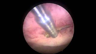 Endometrial polyp [upl. by Selway]