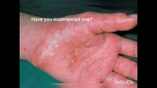 What is dyshidrotic eczema [upl. by Lesirg]