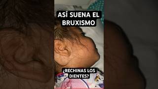 ¿Tu HIJOA RECHINA los DIENTES al DORMIR 📢 Así suena el BRUXISMO INFANTIL [upl. by Wettam]