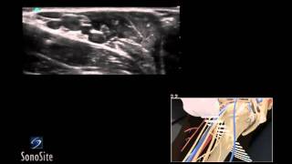 How To Ultrasound Guided Axillary Nerve Block 3D Video [upl. by Lacie]