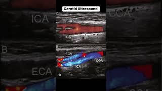 Carotid Ultrasound [upl. by Tingey]