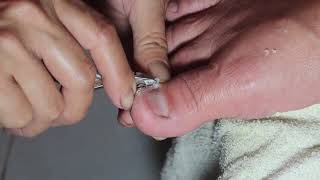 Transforming Ugly Toenails to Naturally Beautiful [upl. by Eelsew]