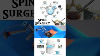 Spine Surgery with Duo™ Ti Expandable Interbody Fusion System from Spineology 3danimation short [upl. by Karlotte45]