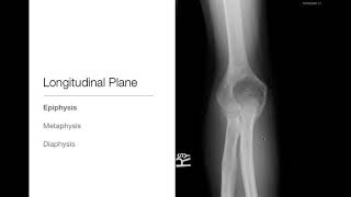 Bone Tumors  Location  Basic Radiology [upl. by Lilian]