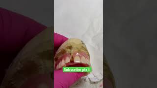 Flexible valplast partíal dentures shortvideo fypシ denturecare [upl. by Rochell]