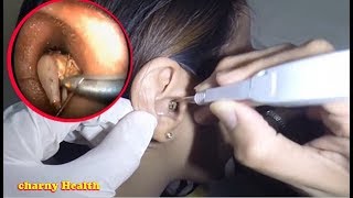 Ear cleaning in usa EXPLODE after Blocked Ear Wax Removal using Endoscopic Ear Microsuction [upl. by Eissehc]