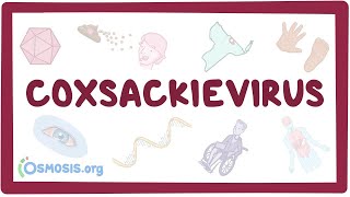 Coxsackievirus  an Osmosis Preview [upl. by Hut255]