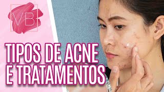 Acne tipos causas e melhores tratamentos  receita caseira  Você Bonita 101121 [upl. by Creath169]