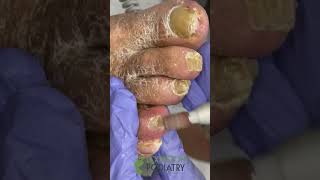 Satisyfing dremel on fungal toenails clips feet fungus nails podiatry [upl. by Tnecillim977]