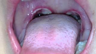 pharyngitis post tonsillectomy [upl. by Nawram933]